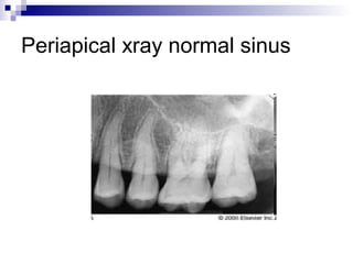 Periapical xray normal sinus
 