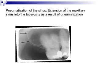Pneumatization of the sinus. Extension of the maxillary
sinus into the tuberosity as a result of pneumatization
 
