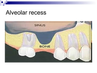 Alveolar recess
 