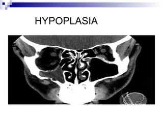HYPOPLASIA
 
