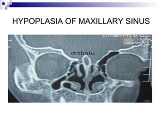 HYPOPLASIA OF MAXILLARY SINUS
 