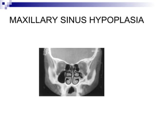 MAXILLARY SINUS HYPOPLASIA
 