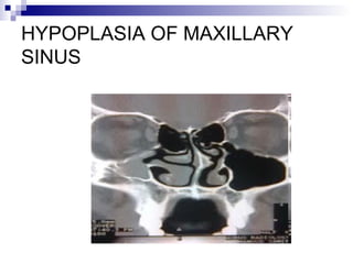 HYPOPLASIA OF MAXILLARY
SINUS
 