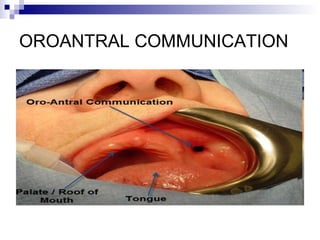 OROANTRAL COMMUNICATION
 