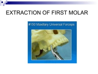 EXTRACTION OF FIRST MOLAR
 