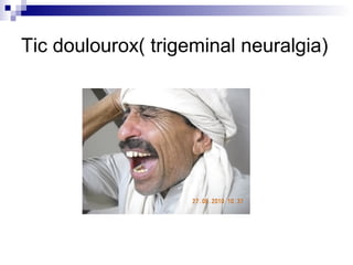 Tic doulourox( trigeminal neuralgia)
 