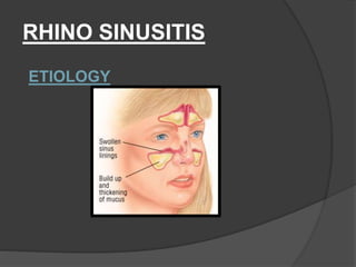 ETIOLOGY
RHINO SINUSITIS
 