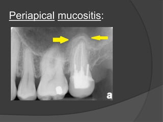Periapical mucositis:
 