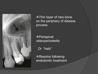 Thin layer of new bone
on the periphery of disease
process
Periapical
osteoperiosteitis
Or “halo”
Resolve following
endodontic treatment
 