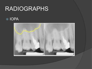 RADIOGRAPHS
 IOPA
 