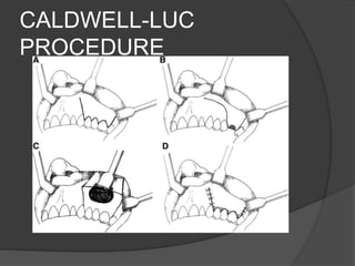 CALDWELL-LUC
PROCEDURE
 