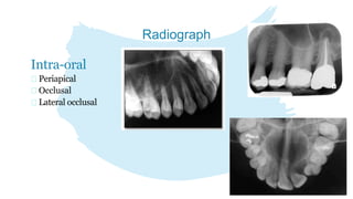 Maxillary sinus | PPTX