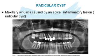  Maxillary sinusitis caused by an apical inflammatory lesion (
radicular cyst)
RADICULAR CYST
 