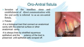 Oro-Antral fistula
 Invasion of the maxillary sinus and
establishment of direct communication with
the oral cavity is referred to as an oro-antral
fistula.
 Fistula:
-It is a biological tract that connect an anatomical
cavity with the external surface or other
anatomical cavity.
-It is always lines by stratified squamous
epithelium and the potency of the tract is
preserved until epithelial cells scraped off.
 
