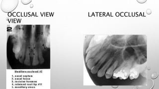 OCCLUSAL VIEW LATERAL OCCLUSAL
VIEW
 