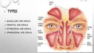 TYPES
 MAXILLARY AIR SINUS.
 FRONTAL AIR SINUS.
 ETHMOIDAL AIR SINUS.
 SPHENOIDAL AIR SINUS.
 