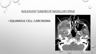 MALIGNANT TUMORS OF MAXILLARY SINUS
• SQUAMOUS CELL CARCINOMA
 