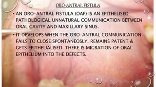 ORO-ANTRAL FISTULA
• AN ORO-ANTRAL FISTULA (OAF) IS AN EPITHELISED
PATHOLOGICAL UNNATURAL COMMUNICATION BETWEEN
ORAL CAVITY AND MAXILLARY SINUS.
• IT DEVELOPS WHEN THE ORO-ANTRAL COMMUNICATION
FAILS TO CLOSE SPONTANEOSLY, REMAINS PATENT &
GETS EPITHELIALISED. THERE IS MIGRATION OF ORAL
EPITHELIUM INTO THE DEFECTS.
 