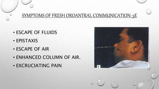 SYMPTOMS OF FRESH OROANTRAL COMMUNICATION: 5E
• ESCAPE OF FLUIDS
• EPISTAXIS
• ESCAPE OF AIR
• ENHANCED COLUMN OF AIR.
• EXCRUCIATING PAIN
 