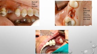 Buccal
Flap
Incisio
n Site
sutured
after
Closing
commun
ica-tion
 