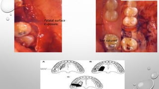 Palatal surface
exposure
Site sutured
 