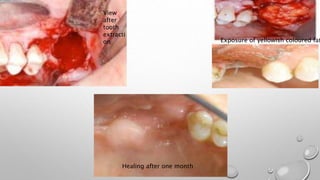 View
after
tooth
extracti
on Exposure of yellowish coloured fat
Healing after one month
 