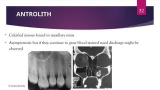 MAXILLARY SINUS ( For Prosthodontics Purpose )- Dr. Akshay G. Muchate.pptx
