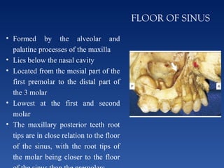 MAXILLARY SINUS - Final.pptxxxxxxxxxxxxxxx | PPTX