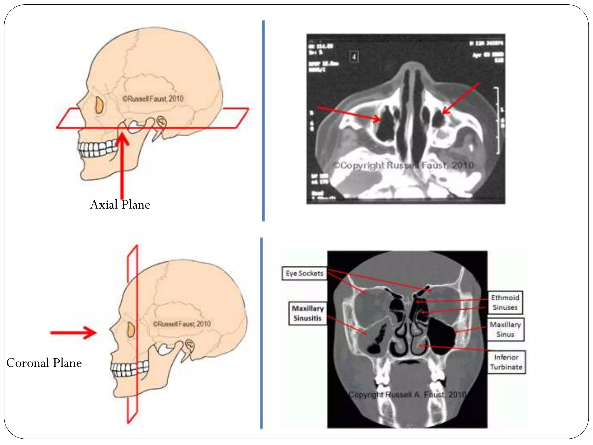 Maxillary sinus carcinoma | PPTX