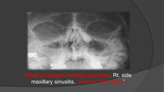 Water’s (occipito-mental) projection. Rt. side
maxillary sinusitis. note the “fluid level”
 