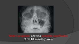 Water’s projection, showing complete opacification
of the Rt. maxillary sinus
 
