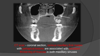 CT scan - coronal section, carious maxillary first molars
with periapical lesions are associated with localized
thickening of mucosa in both maxillary sinuses
 