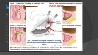 Management
 Non surgical
 Antral regimen ; bed rest ,plenty of fluids maintenance of oral
hygiene
 Antibiotics (Amoxicillin is the first line)
 Anti inflammatory (corticosteroids) for chronic cases
 Analgesics
 nasal decongestants
 mucolytic agents
 Steam inhalation
 Surgical approaches
 Surgical drainage of pus and lavage of sinus cavity.
 Caldwell-luc surgery
 