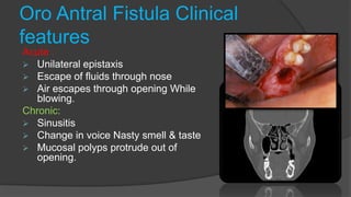 Oro Antral Fistula Clinical
features
Acute :
 Unilateral epistaxis
 Escape of fluids through nose
 Air escapes through opening While
blowing.
Chronic:
 Sinusitis
 Change in voice Nasty smell & taste
 Mucosal polyps protrude out of
opening.
 