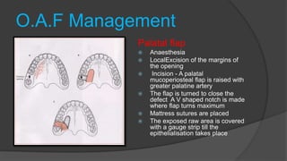O.A.F Management
Palatal flap
 Anaesthesia
 LocalExcision of the margins of
the opening
 Incision - A palatal
mucoperiosteal flap is raised with
greater palatine artery
 The flap is turned to close the
defect A V shaped notch is made
where flap turns maximum
 Mattress sutures are placed
 The exposed raw area is covered
with a gauge strip till the
epithelialisation takes place
 