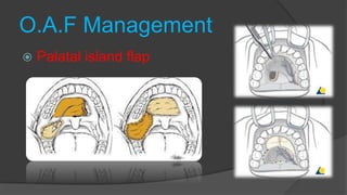 O.A.F Management
 Palatal island flap
 