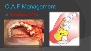 O.A.F Management
 Buccal pad of fat
 