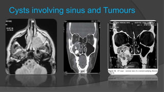 Cysts involving sinus and Tumours
 