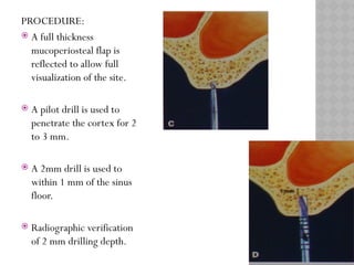 MAXILLARY SINUS ELEVATION floor for implant | PPTX