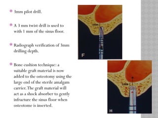 MAXILLARY SINUS ELEVATION floor for implant | PPTX