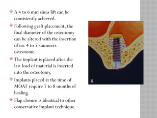 MAXILLARY SINUS ELEVATION floor for implant | PPTX