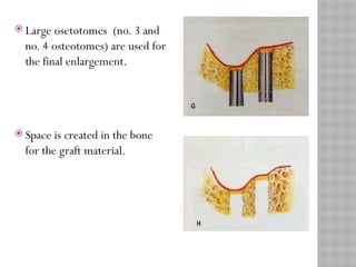 MAXILLARY SINUS ELEVATION floor for implant | PPTX