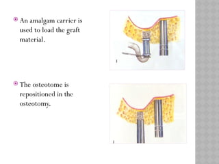 MAXILLARY SINUS ELEVATION floor for implant | PPTX