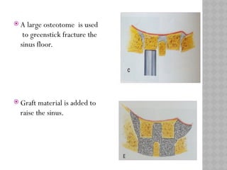 MAXILLARY SINUS ELEVATION floor for implant | PPTX