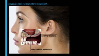 SINUS FLOOR ELEVATION TECHNIQUES
LATERAL WINDOW
TRANSCRESTAL APPROACH
 