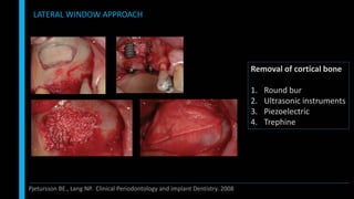 LATERAL WINDOW APPROACH
Pjetursson BE., Lang NP. Clinical Periodontology and implant Dentistry. 2008
Removal of cortical bone
1. Round bur
2. Ultrasonic instruments
3. Piezoelectric
4. Trephine
 
