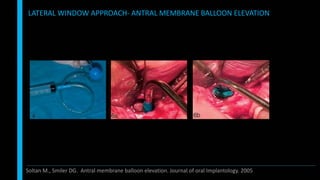 LATERAL WINDOW APPROACH- ANTRAL MEMBRANE BALLOON ELEVATION
Soltan M., Smiler DG. Antral membrane balloon elevation. Journal of oral Implantology. 2005
 