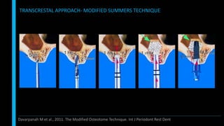 TRANSCRESTAL APPROACH- MODIFIED SUMMERS TECHNIQUE
Davarpanah M et al., 2011. The Modified Osteotome Technique. Int J Periodont Rest Dent
 