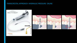 TRANSCRESTAL APPROACH- HYDRAULIC PRESSURE- SALINE
 