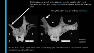 Coronal
sections
The intraosseous branch of the posterior superior alveolar artery most
frequently runs through a bony groove inside the lateral wall of the maxillary
sinus.
Rarely the artery may run within a bony canal.
Hur MS et al., 2009. Clinical implications of the topography and distribution of the posterior superior
alveolar artery. J Craniofac Surg.
 